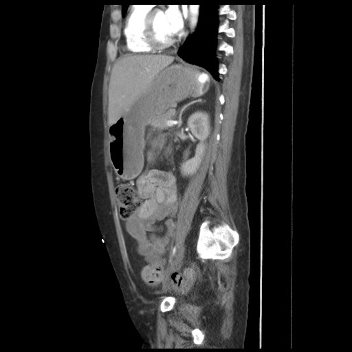 File:Aorto-duodenal fistula (Radiopaedia 25668-25850 C+ arterial phase 14).jpg