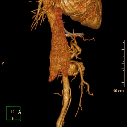 File:Aorto-left renal vein fistula (Radiopaedia 45534-49628 D 16).jpg