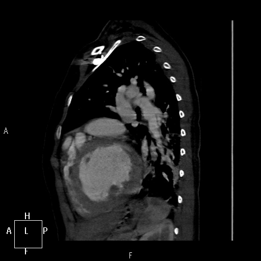 File:Aortopulmonary septal defect (Radiopaedia 41990-45013 Sagittal C+ CTPA 10).jpg