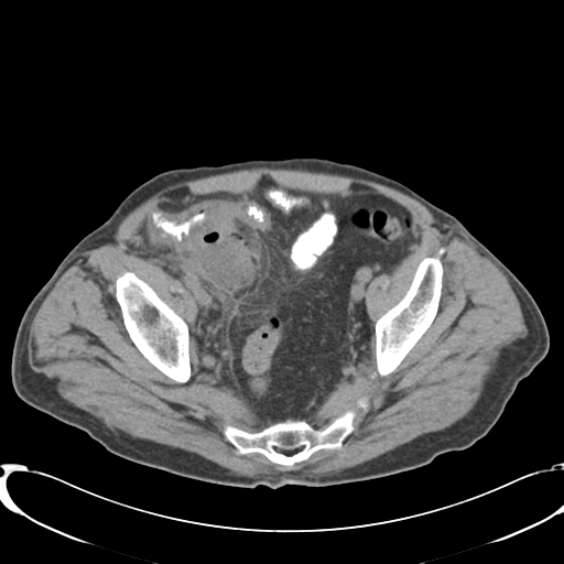 File:Appendiceal abscesses (Radiopaedia 50999-56542 Axial non-contrast 68).png