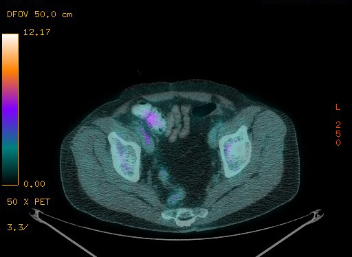 Appendiceal adenocarcinoma complicated by retroperitoneal abscess (Radiopaedia 58007-65041 Axial PET-CT 176).jpg