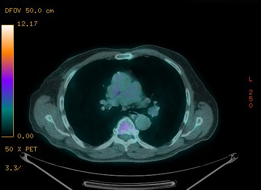 Appendiceal adenocarcinoma complicated by retroperitoneal abscess (Radiopaedia 58007-65041 Axial PET-CT 65).jpg