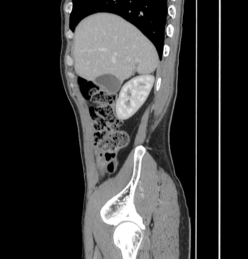 Appendiceal mucinous adenocarcinoma (Radiopaedia 66605-75922 C 13).jpg