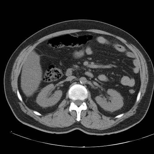 File:Appendicitis and giant appendicolith (Radiopaedia 80251-93588 Axial non-contrast 21).jpg