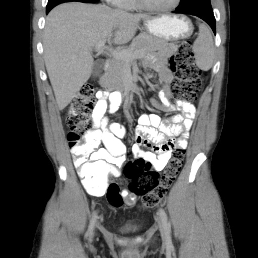 File:Appendicitis complicated by post-operative collection (Radiopaedia 35595-37113 B 22).jpg