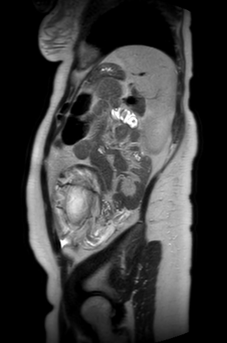 Appendicitis in gravida (MRI) (Radiopaedia 89433-106395 Sagittal T2 16).jpg