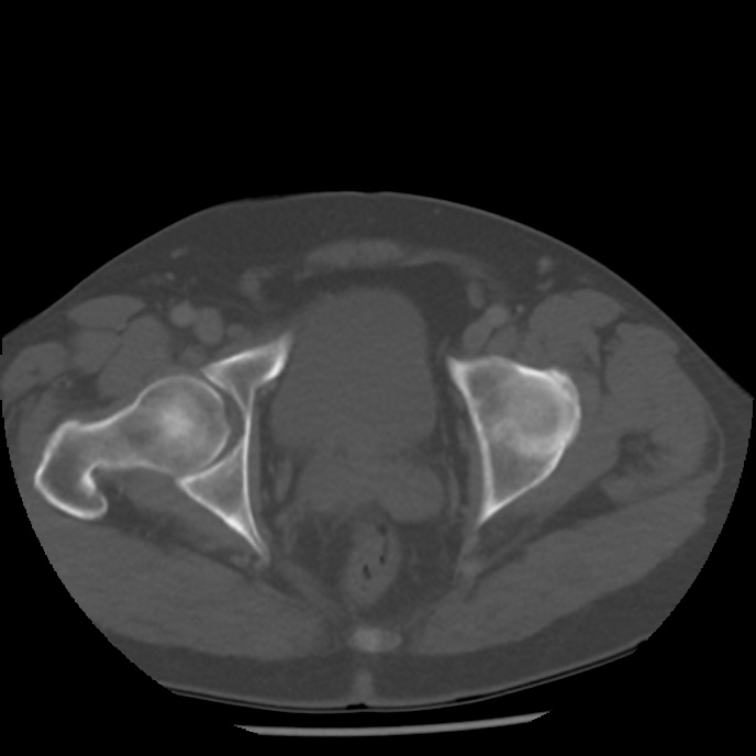 Appendicitis with perforation (Radiopaedia 35790-37342 Axial bone window 50).jpg