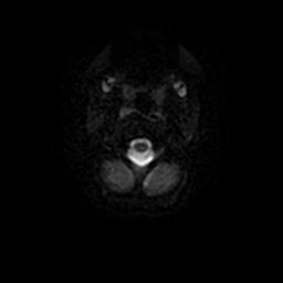 Arachnoid cyst - middle cranial fossa (Radiopaedia 67671-77088 Axial DWI 28).jpg