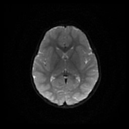 Arachnoid cyst - middle cranial fossa (Radiopaedia 86780-102938 Axial DWI 43).jpg