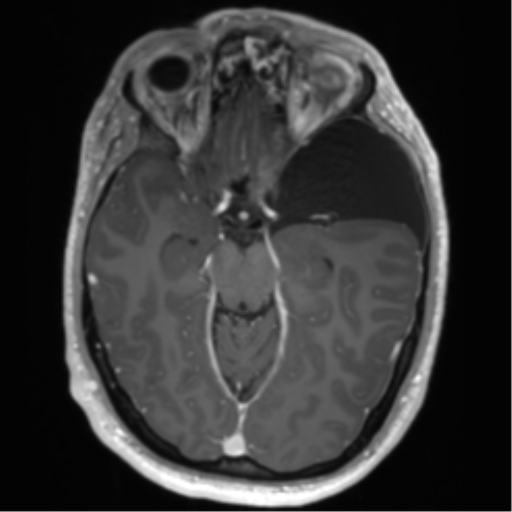 Arachnoid cyst with subdural hematoma (Radiopaedia 85892-101743 Axial T1 C+ 36).png