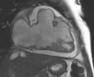 Arrhythmogenic right ventricular cardiomyopathy (Radiopaedia 69431-79307 2ch cine 70).jpg