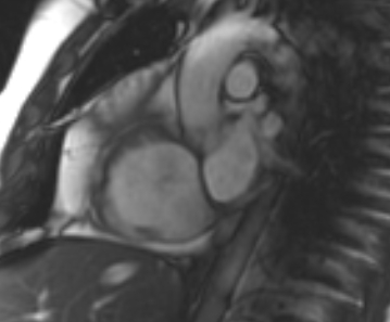File:Arrhythmogenic right ventricular cardiomyopathy (Radiopaedia 69431-79307 Short axis cine 227).jpg