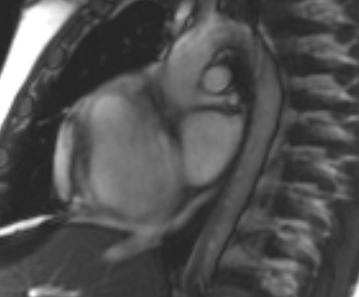 Arrhythmogenic right ventricular cardiomyopathy (Radiopaedia 69431-79307 Short axis cine 253).jpg