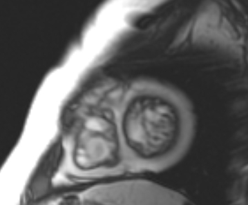 Arrhythmogenic right ventricular cardiomyopathy (Radiopaedia 69431-79307 Short axis cine 37).jpg