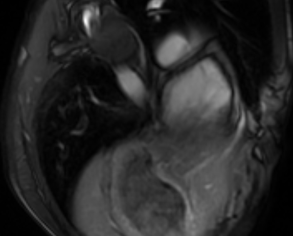 Arrhythmogenic right ventricular cardiomyopathy (Radiopaedia 69564-79464 4ch cine 150).jpg
