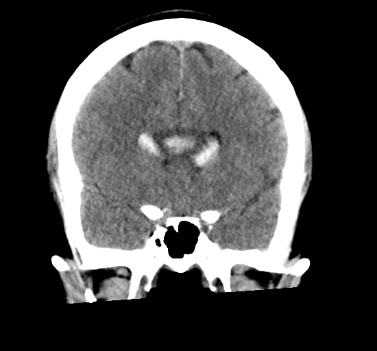 File:Arteriovenous malformation (cerebral) (Radiopaedia 40070-42579 Coronal non-contrast 15).png
