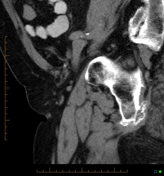 File:Artificial urethral sphincter (Radiopaedia 46937-51464 Sagittal C+ delayed 9).jpg
