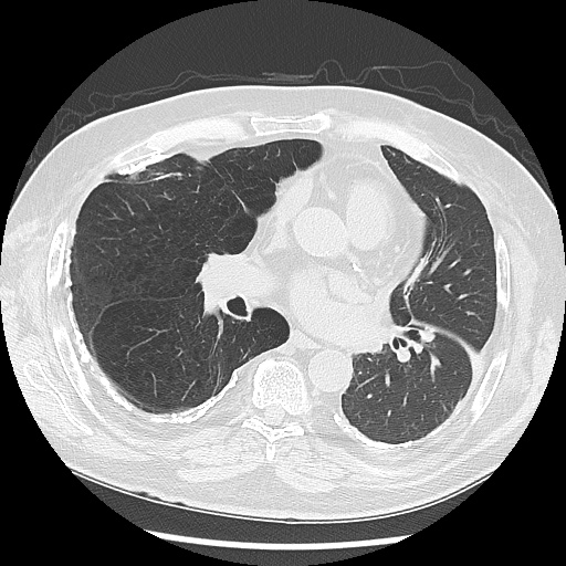 Asbestos-related pleural disease (Radiopaedia 74366-85250 Axial lung window 62).jpg