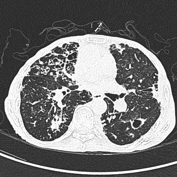 Aspergilloma- with Monod sign (Radiopaedia 44737-48532 Axial lung window 134).jpg