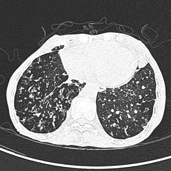 Aspergilloma- with Monod sign (Radiopaedia 44737-48532 Axial lung window 219).jpg