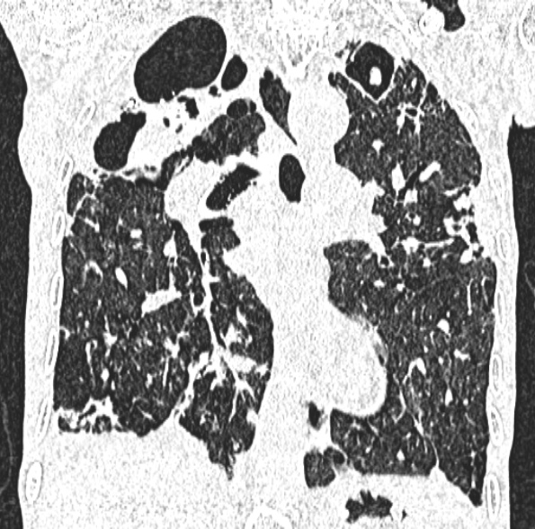 Aspergilloma- with Monod sign (Radiopaedia 44737-48532 Coronal lung window 255).jpg