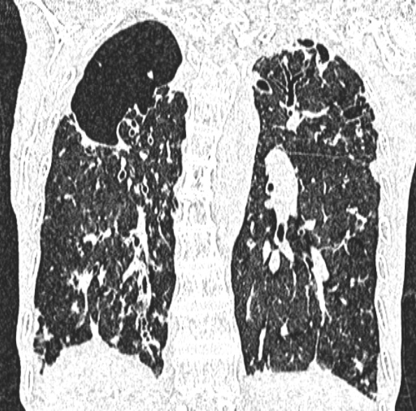 Aspergilloma- with Monod sign (Radiopaedia 44737-48532 Coronal lung window 315).jpg