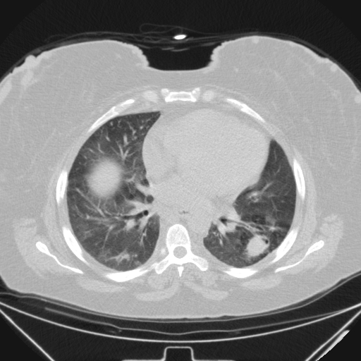 Aspergilloma (Radiopaedia 39611-41932 Axial lung window 71).jpg