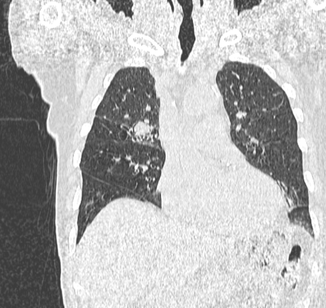 Aspergilloma (Radiopaedia 44592-48327 Coronal lung window 46).jpg