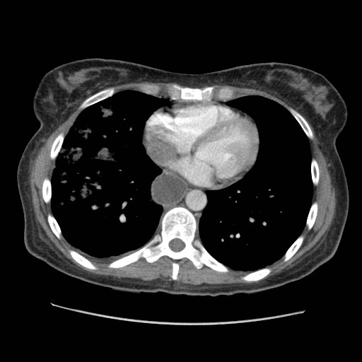 Aspiration pneumonia secondary to laparoscopic banding (Radiopaedia 18345-18183 A 35).jpg