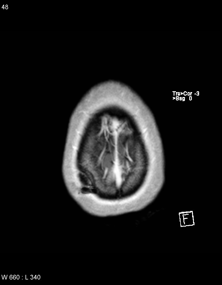 Astroblastoma (Radiopaedia 39792-42218 Axial T1 C+ 47).jpg