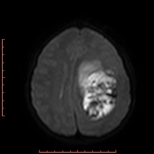 Astroblastoma (Radiopaedia 74287-85162 Axial DWI 66).jpg