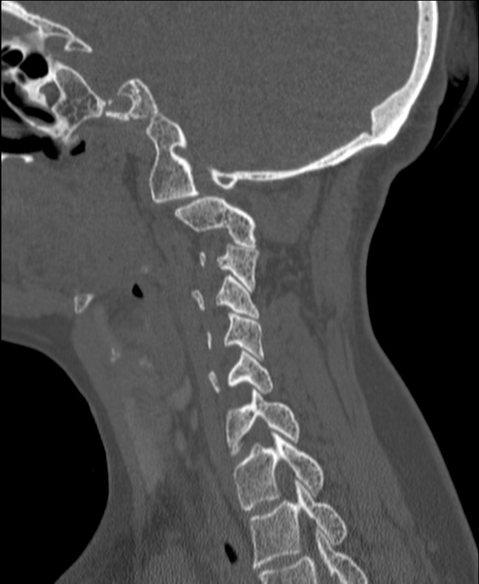 Atlanto-occipital assimilation with basilar invagination (Radiopaedia 70122-80188 Sagittal bone window 104).jpg