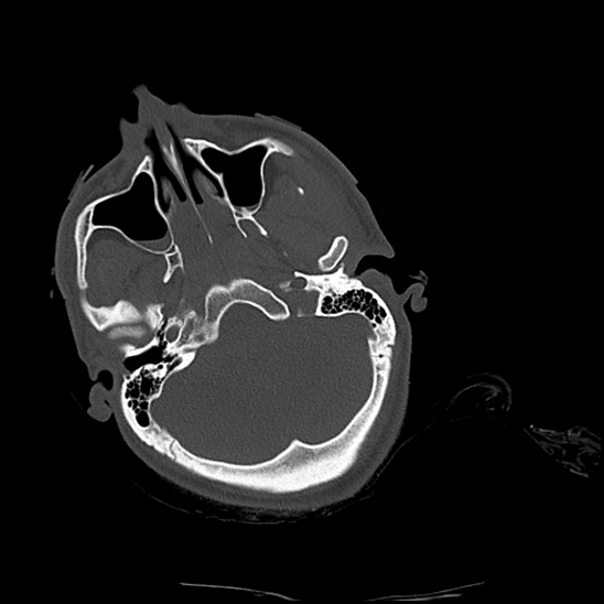 Atlanto-occipital dissociation (Traynelis type 1), C2 teardrop fracture, C6-7 facet joint dislocation (Radiopaedia 87655-104061 Axial bone window 4).jpg