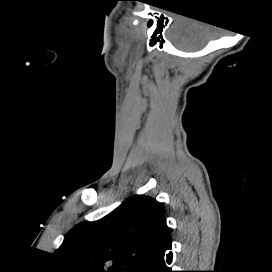 Atlanto-occipital dissociation (Traynelis type 1), C2 teardrop fracture, C6-7 facet joint dislocation (Radiopaedia 87655-104061 D 69).jpg