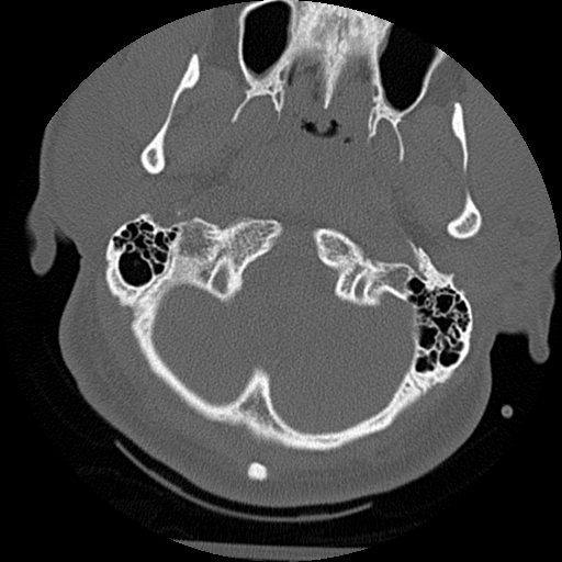 File:Atlanto-occipital dissociation injury (Radiopaedia 29274-29698 Axial bone window 6).png