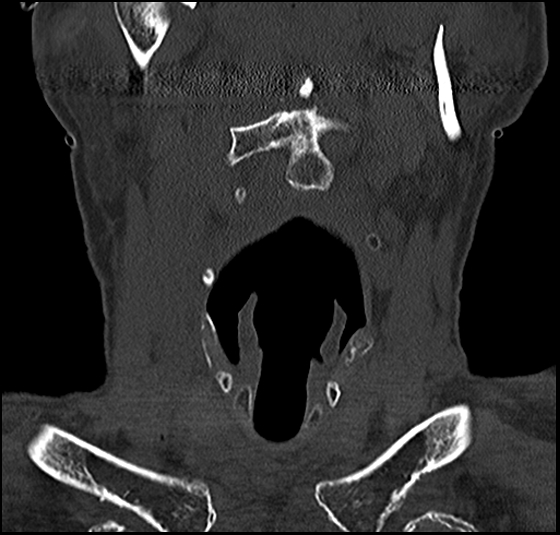 Atlas (type 3b subtype 1) and axis (Anderson and D'Alonzo type 3, Roy-Camille type 2) fractures (Radiopaedia 88043-104607 Coronal bone window 14).jpg