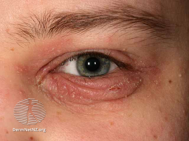 File:Atopic dermatitis (DermNet NZ site-age-specific-s-atopicbleph1).jpg