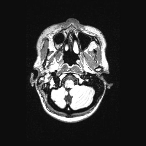 File:Atretic encephalocoele with inferior vermis hypoplasia (Radiopaedia 30443-31108 Axial 26).jpg