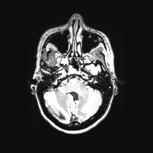 Atretic encephalocoele with inferior vermis hypoplasia (Radiopaedia 30443-31108 Axial 42).jpg