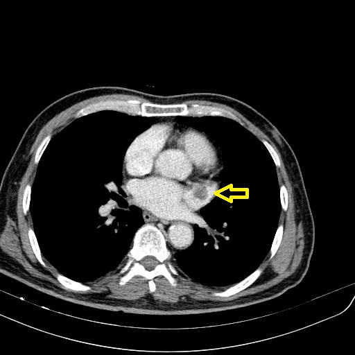 File:Atrial appendage thrombus (Radiopaedia 64241-73017 Axial CT image 1).jpg