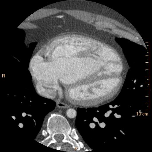 Atrial septal defect (upper sinus venosus type) with partial anomalous pulmonary venous return into superior vena cava (Radiopaedia 73228-83961 A 200).jpg