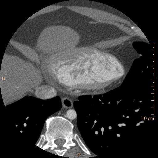 Atrial septal defect (upper sinus venosus type) with partial anomalous pulmonary venous return into superior vena cava (Radiopaedia 73228-83961 A 236).jpg