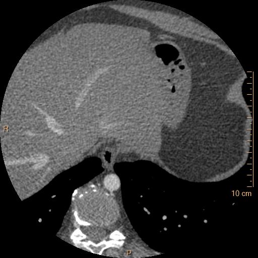 File:Atrial septal defect (upper sinus venosus type) with partial anomalous pulmonary venous return into superior vena cava (Radiopaedia 73228-83961 A 273).jpg