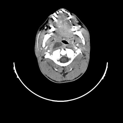 File:Atypical 2nd branchial cleft cyst (type IV) - infected (Radiopaedia 20986-20924 A 7).jpg