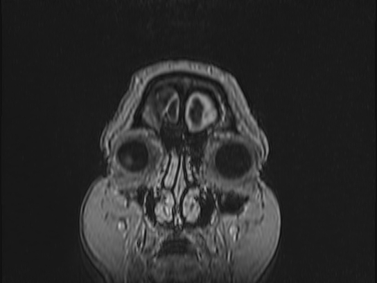 Atypical meningioma (Radiopaedia 62985-71406 Coronal T1 C+ 2).jpg