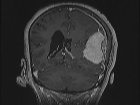 Atypical meningioma (Radiopaedia 62985-71406 Coronal T1 C+ 85).jpg