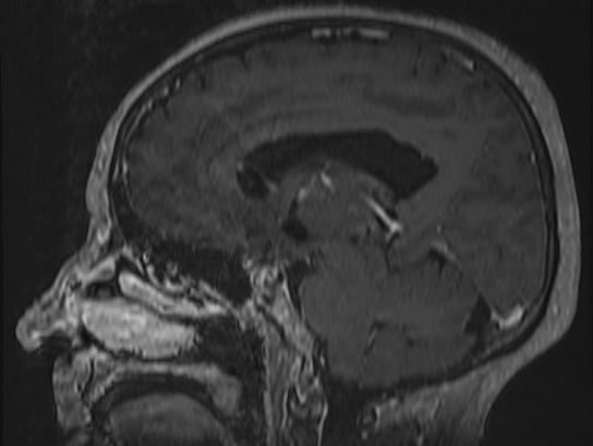 Atypical meningioma (Radiopaedia 62985-71406 Sagittal T1 C+ 39).jpg