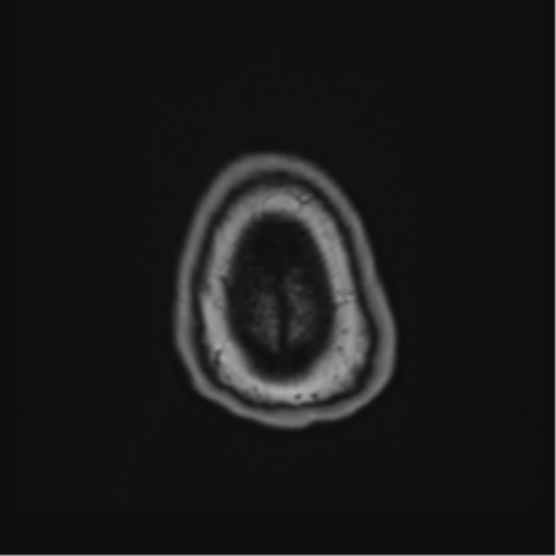 Atypical meningioma (WHO Grade II) (Radiopaedia 54742-60981 Axial T1 70).png