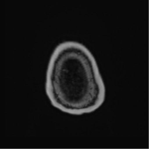 Atypical meningioma (WHO Grade II) (Radiopaedia 54742-60981 Axial T1 C+ 70).png
