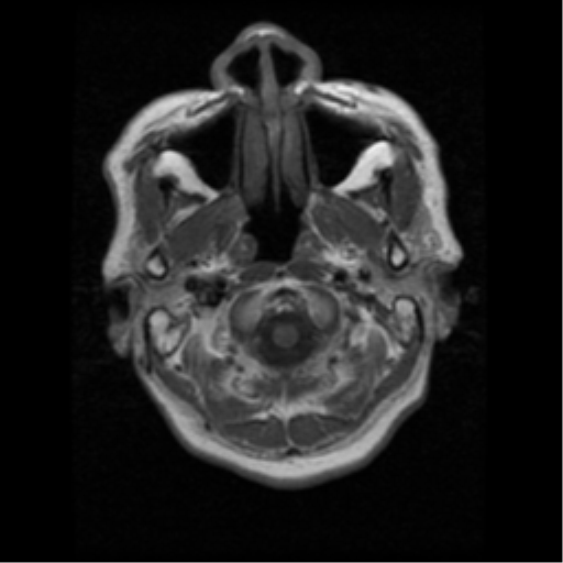 File:Atypical meningioma (WHO grade II) with osseous invasion (Radiopaedia 53654-59716 Axial T1 1).png